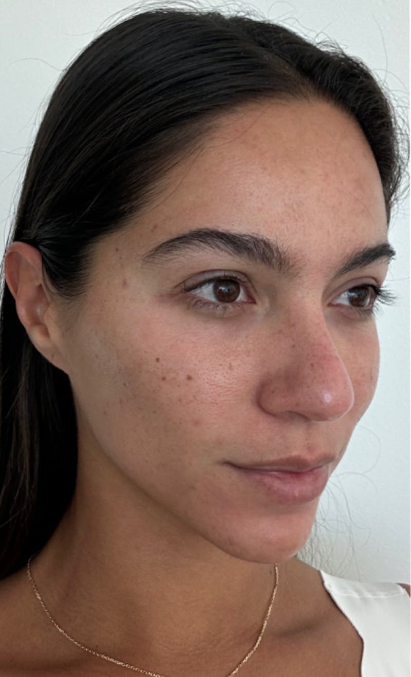 Moxi Laser Before & After Gallery - Patient 416124 - Image 1