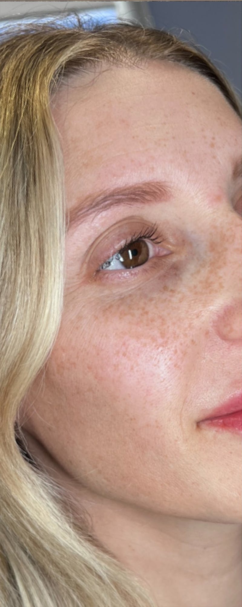 Moxi Laser Before & After Gallery - Patient 259411 - Image 3