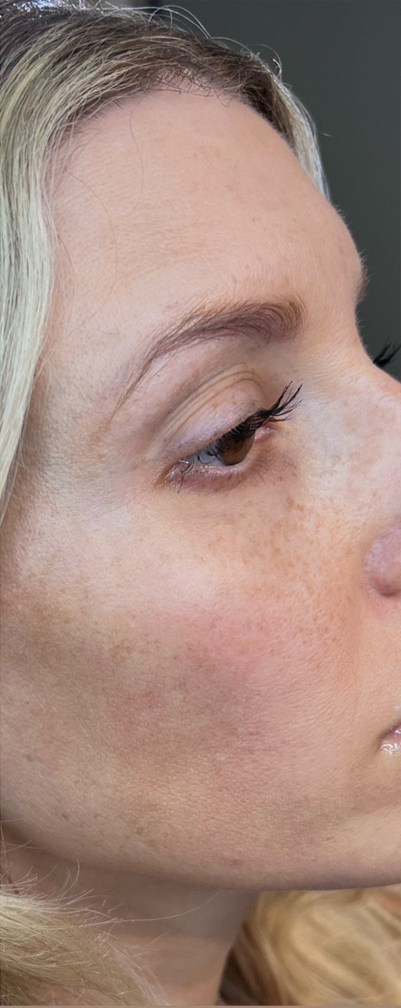 Moxi Laser Before & After Gallery - Patient 259411 - Image 4