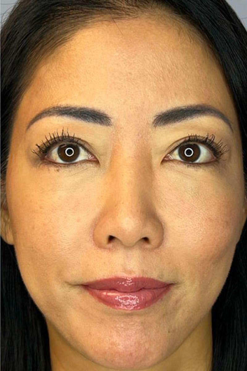 PRF Before & After Gallery - Patient 398603 - Image 2
