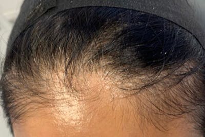 Hair Restoration Before & After Gallery - Patient 273901 - Image 1