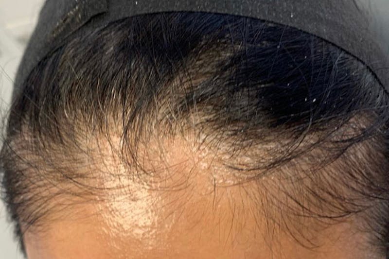 Hair Restoration Before & After Gallery - Patient 273901 - Image 1