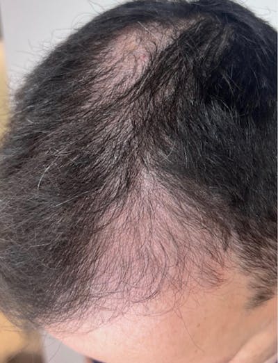 Hair Restoration Before & After Gallery - Patient 299848 - Image 1