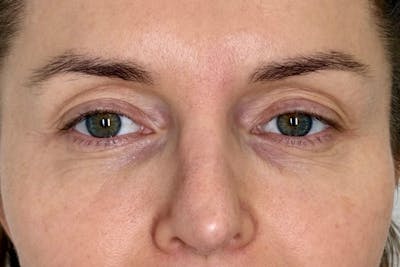 PRF Before & After Gallery - Patient 333905 - Image 2