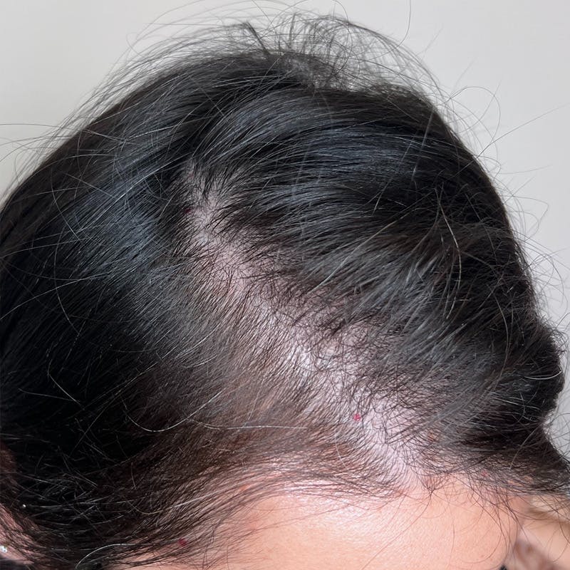 PRF Before & After Gallery - Patient 254442 - Image 3