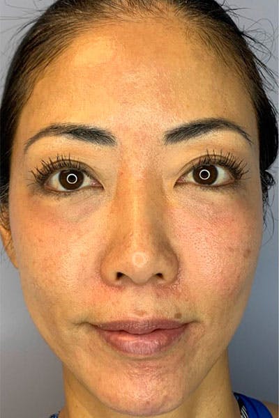 PRF Before & After Gallery - Patient 398603 - Image 1