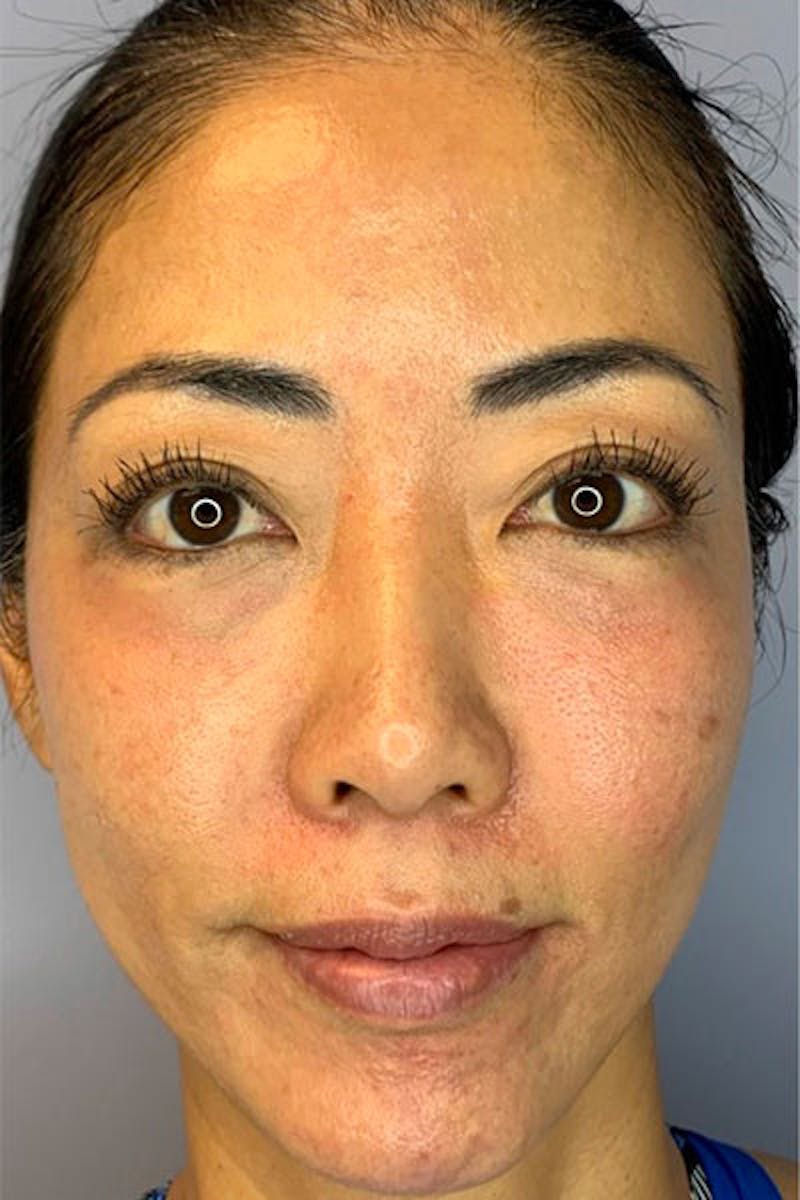 PRF Before & After Gallery - Patient 398603 - Image 1