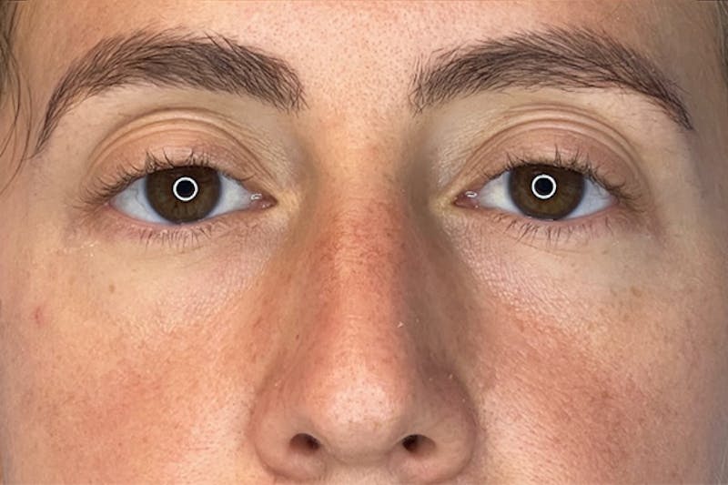 PRF Before & After Gallery - Patient 157870 - Image 2