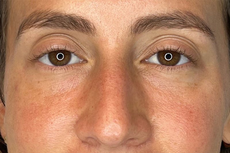 PRF Before & After Gallery - Patient 157870 - Image 1