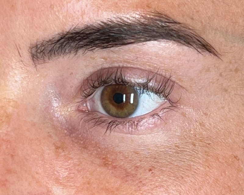 EZ Gel PRF Before & After Gallery - Patient 282199 - Image 1