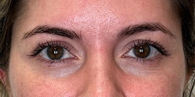 EZ Gel PRF Before & After Gallery - Patient 334612 - Image 1