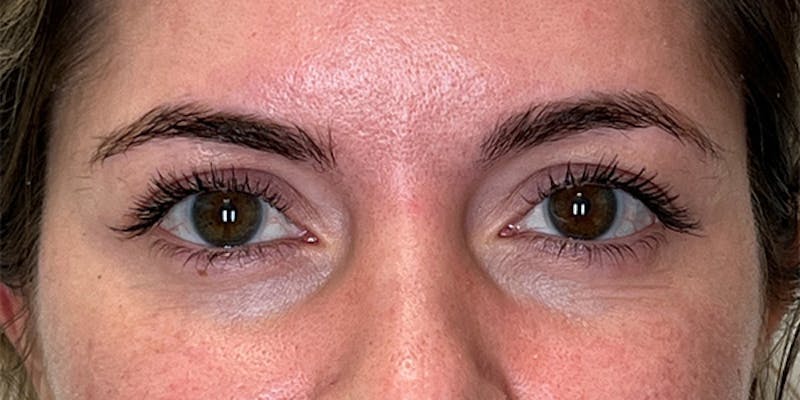 EZ Gel PRF Before & After Gallery - Patient 334612 - Image 1