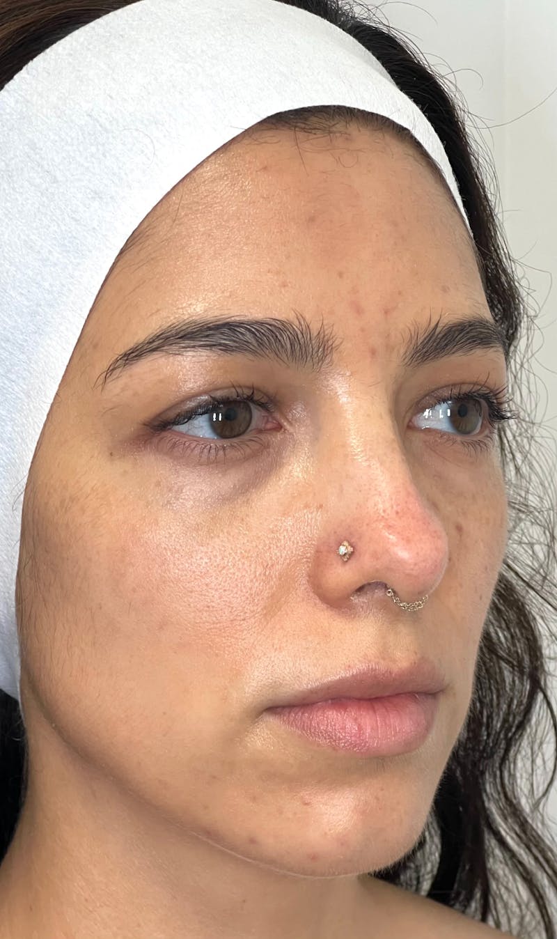 EZ Gel PRF Before & After Gallery - Patient 377189 - Image 1