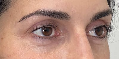 EZ Gel PRF Before & After Gallery - Patient 231825 - Image 1