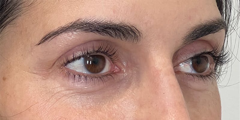 EZ Gel PRF Before & After Gallery - Patient 231825 - Image 1