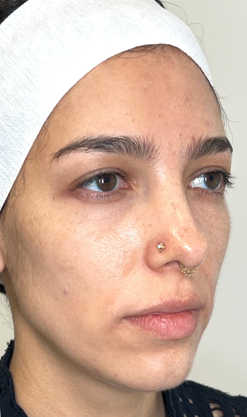 EZ Gel PRF Before & After Gallery - Patient 377189 - Image 2