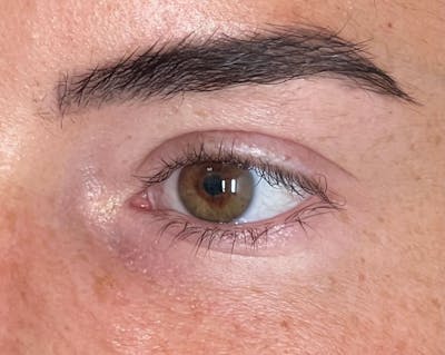 EZ Gel PRF Before & After Gallery - Patient 282199 - Image 2