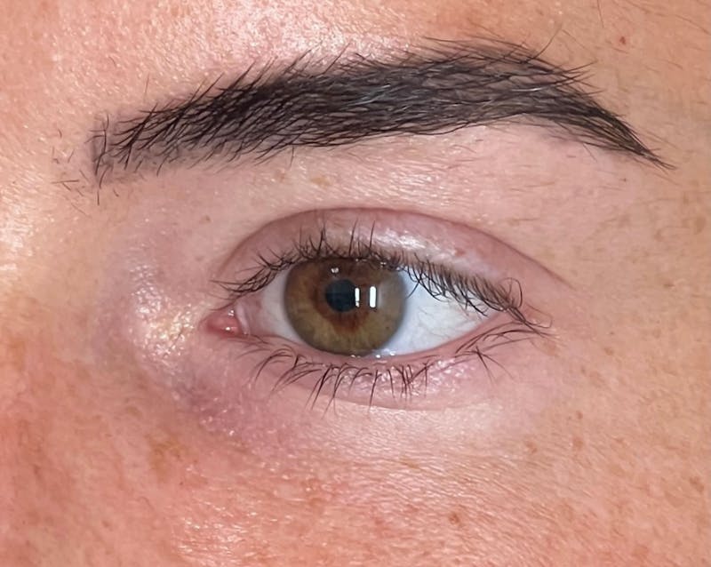 EZ Gel PRF Before & After Gallery - Patient 282199 - Image 2
