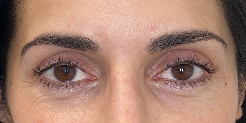 EZ Gel PRF Before & After Gallery - Patient 231825 - Image 3