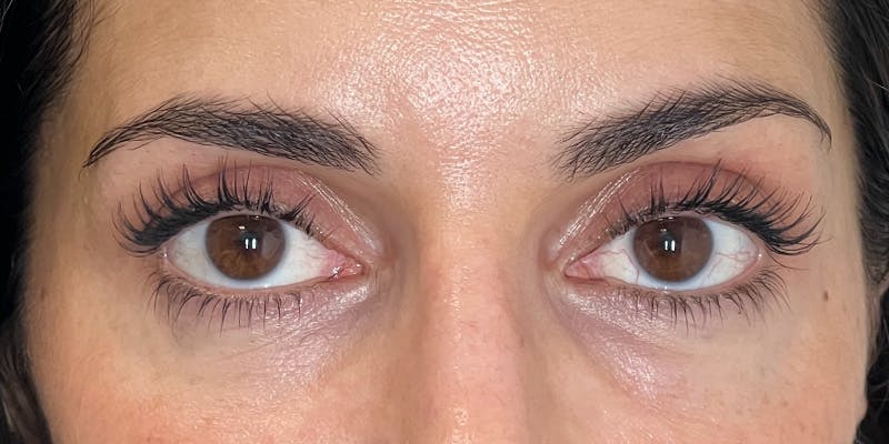 EZ Gel PRF Before & After Gallery - Patient 231825 - Image 4
