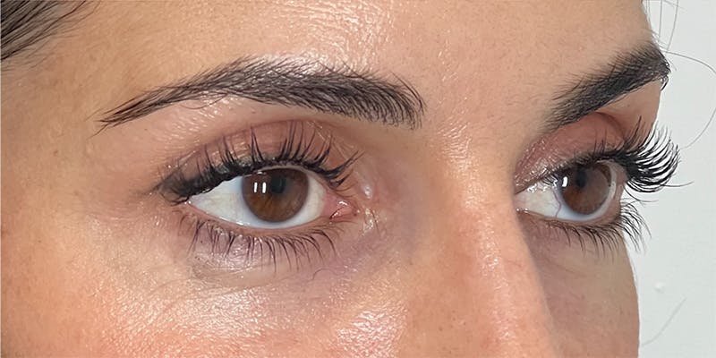 EZ Gel PRF Before & After Gallery - Patient 231825 - Image 2