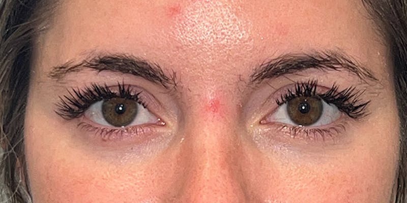 EZ Gel PRF Before & After Gallery - Patient 334612 - Image 2