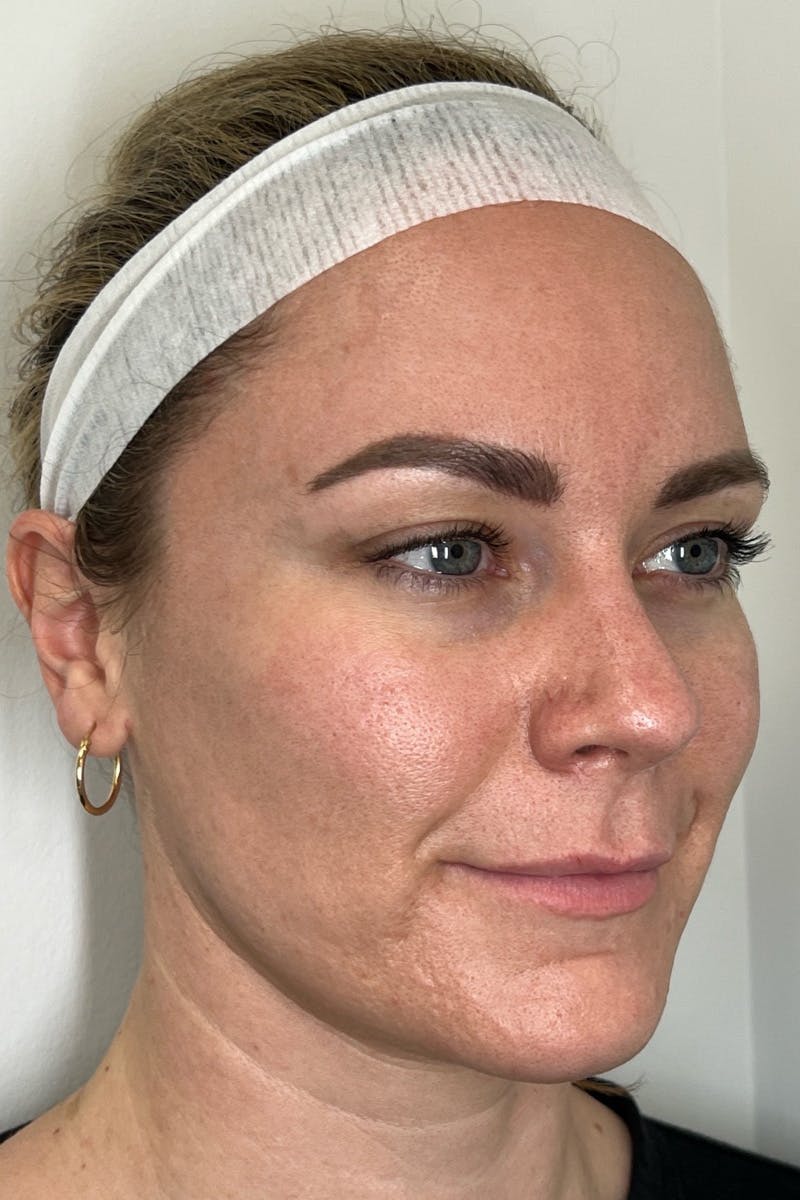 SkinPen Microneedling Before & After Gallery - Patient 353332 - Image 4