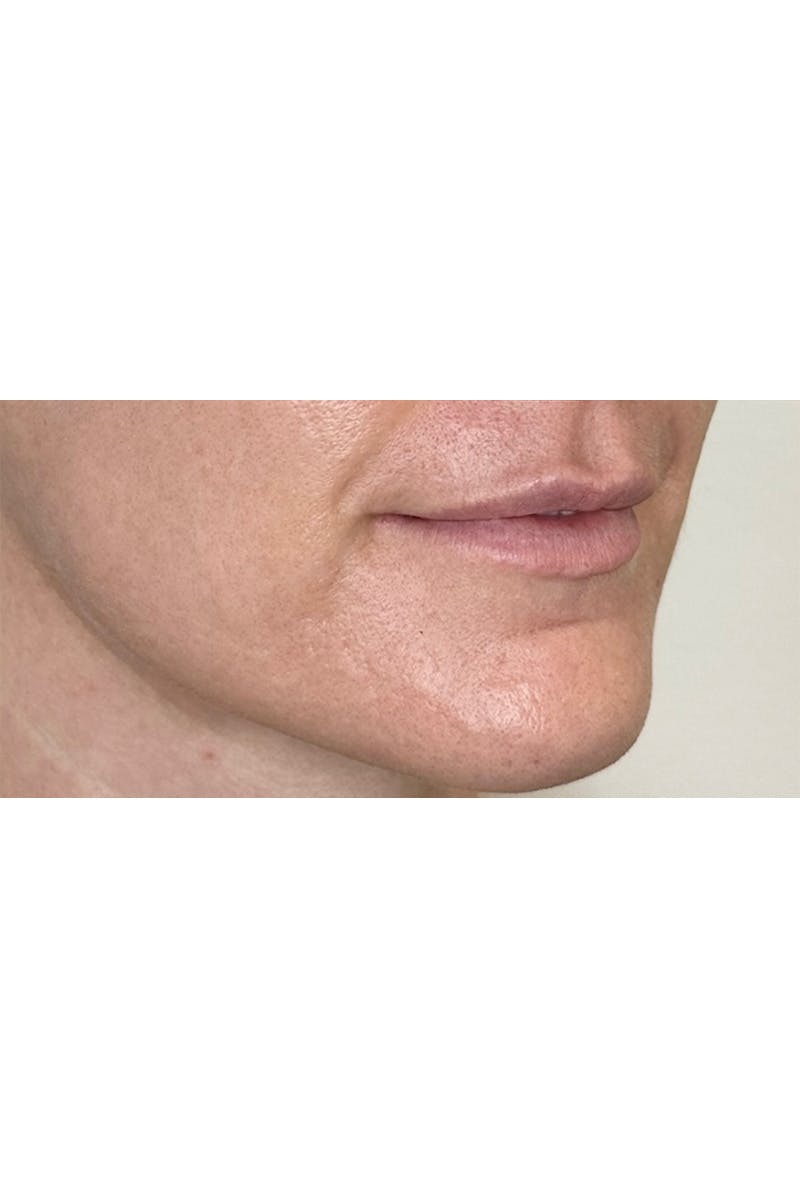 SkinPen Microneedling Before & After Gallery - Patient 353332 - Image 5
