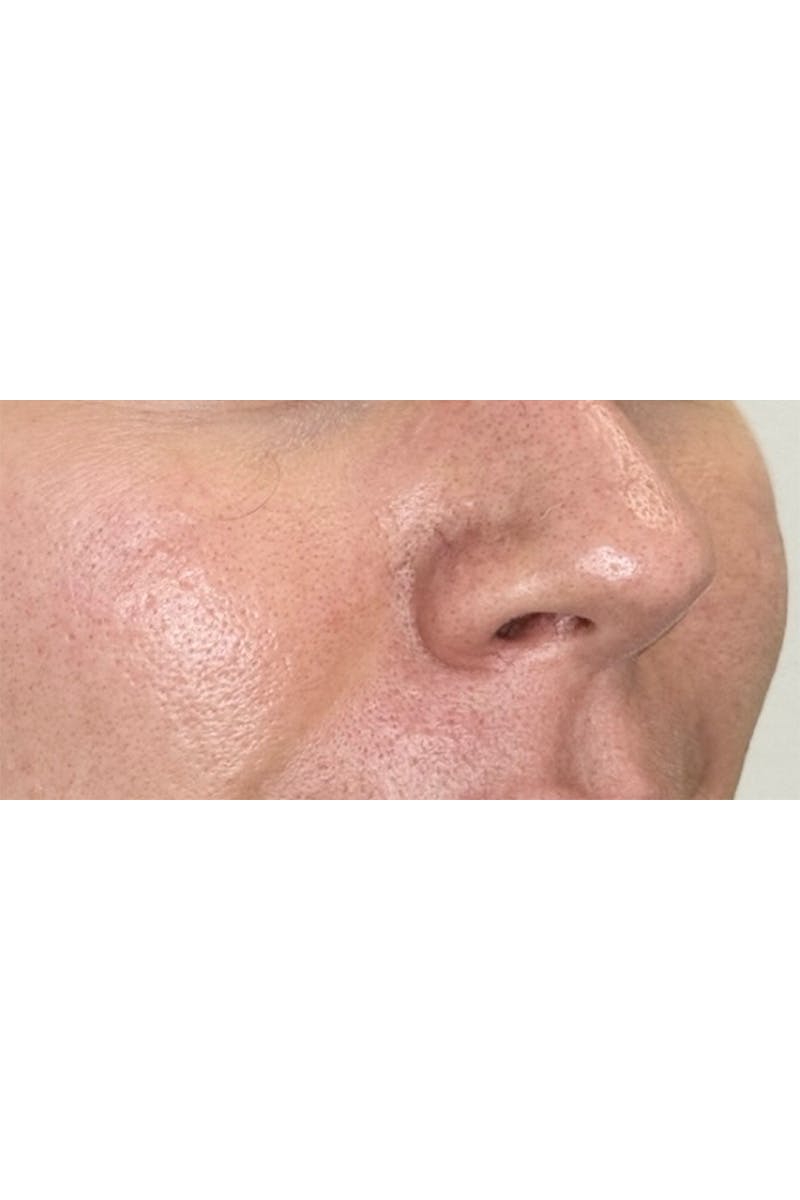 SkinPen Microneedling Before & After Gallery - Patient 353332 - Image 7