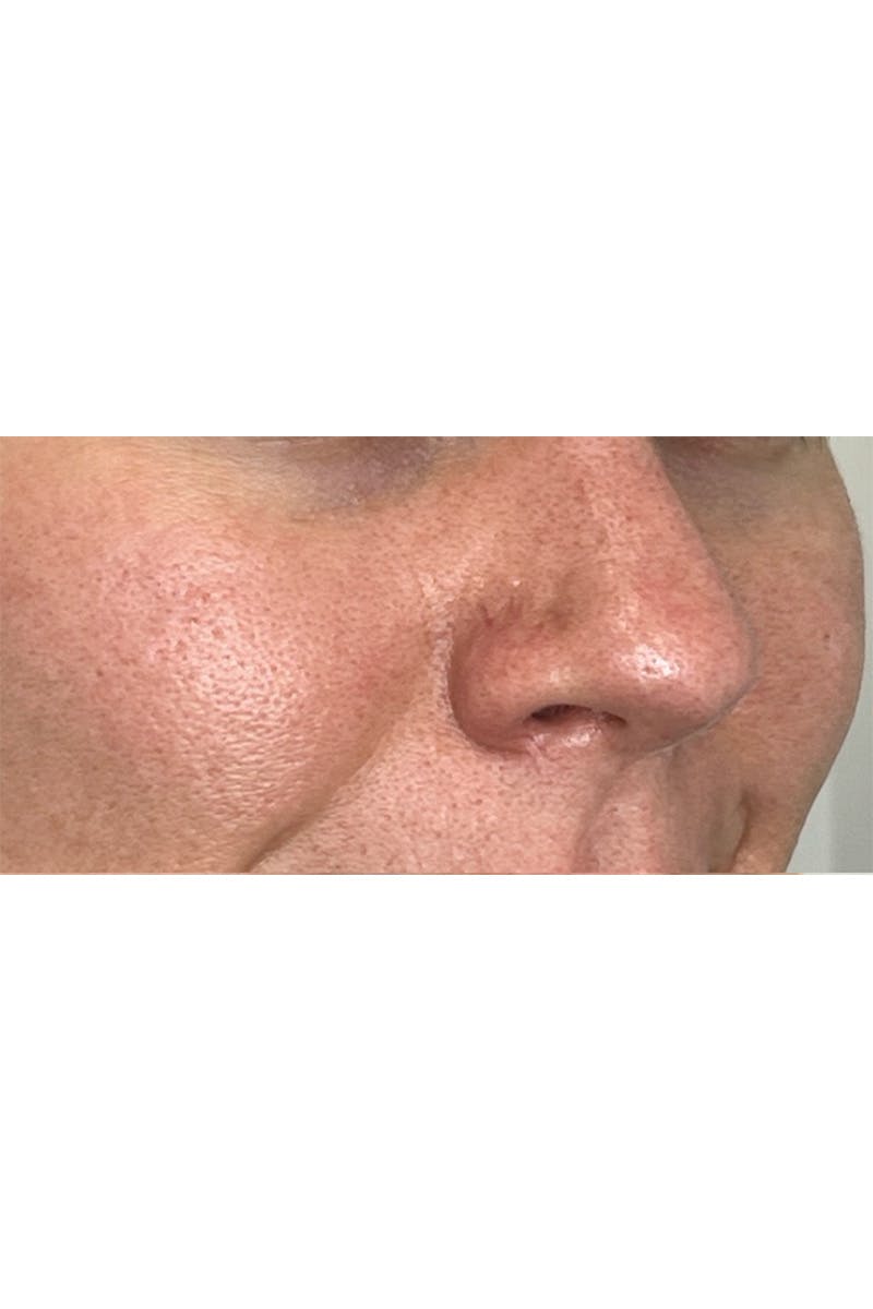 SkinPen Microneedling Before & After Gallery - Patient 353332 - Image 8