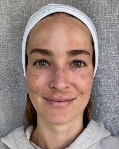 Rejuran Before & After Gallery - Patient 401424 - Image 1