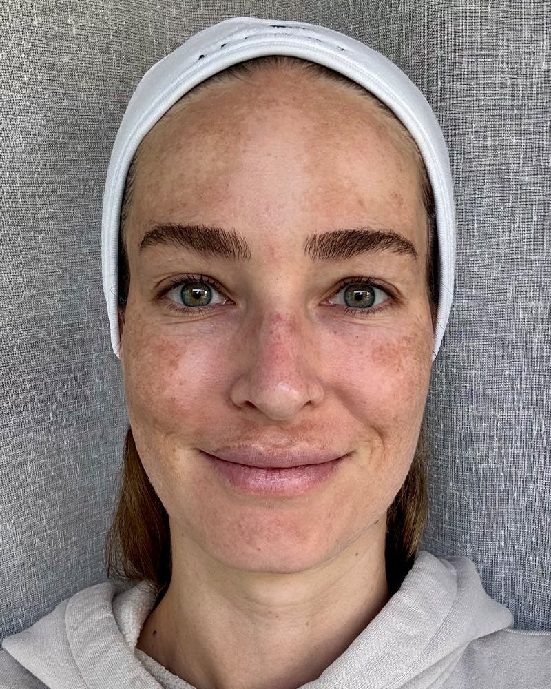 Rejuran Before & After Gallery - Patient 401424 - Image 1