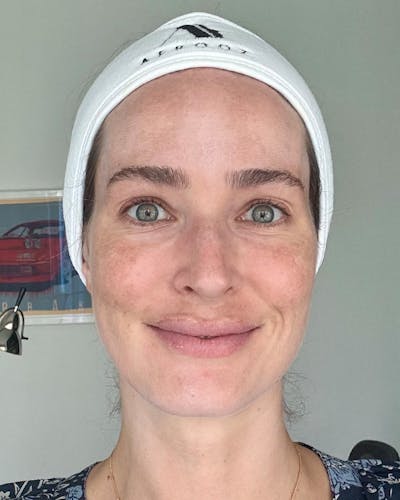 Rejuran Before & After Gallery - Patient 401424 - Image 2