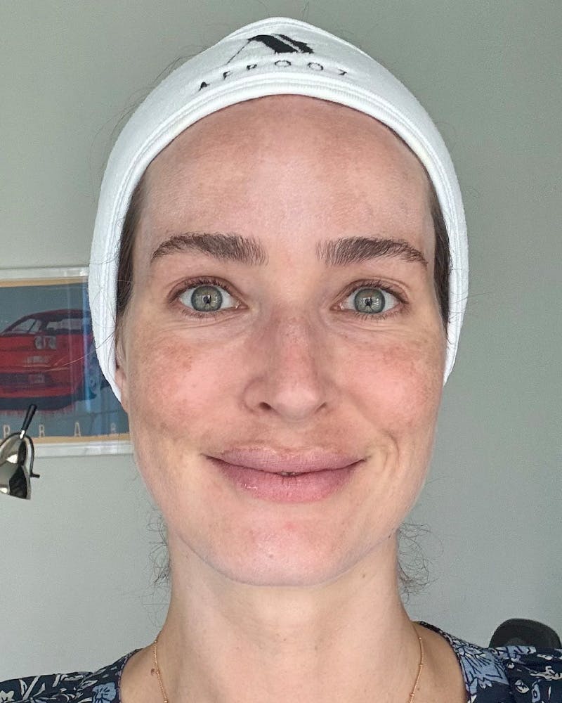 Rejuran Before & After Gallery - Patient 401424 - Image 2