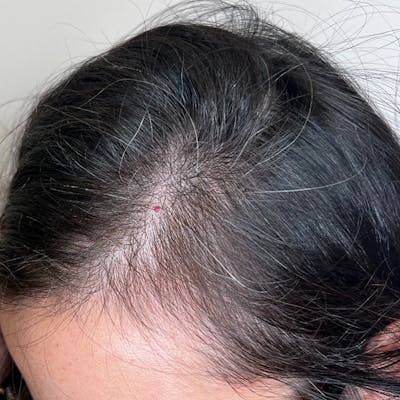 Hair Restoration Before & After Gallery - Patient 290606 - Image 1