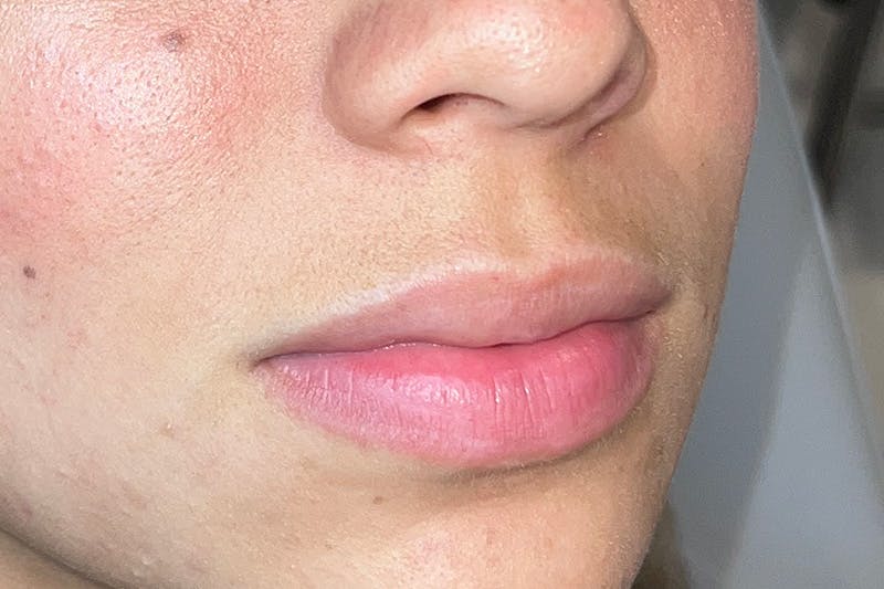 Lip Filler Before & After Gallery - Patient 410936 - Image 3