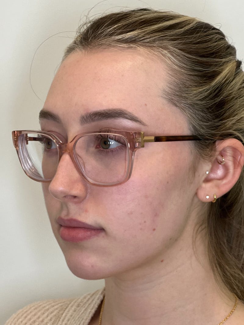 Facial Filler Before & After Gallery - Patient 201265 - Image 1