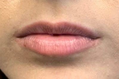 Lip Filler Before & After Gallery - Patient 118787 - Image 1