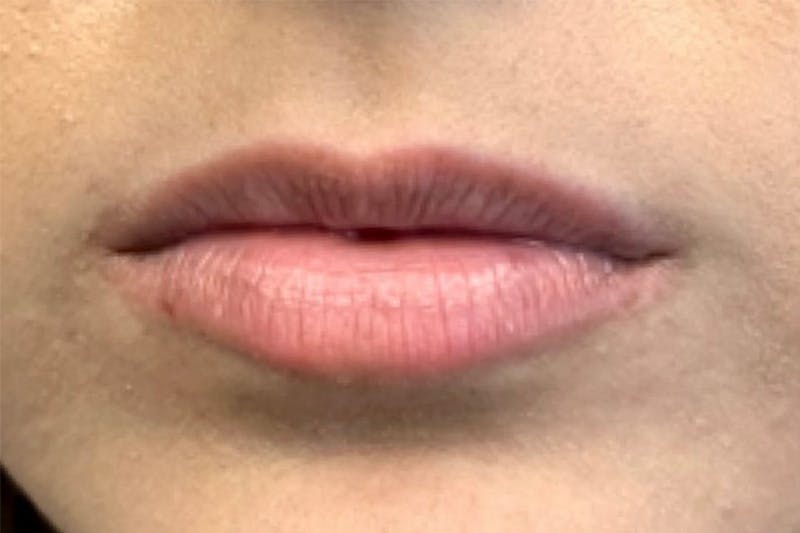 Lip Filler Before & After Gallery - Patient 118787 - Image 1