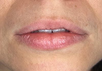 Lip Filler Before & After Gallery - Patient 435849 - Image 1