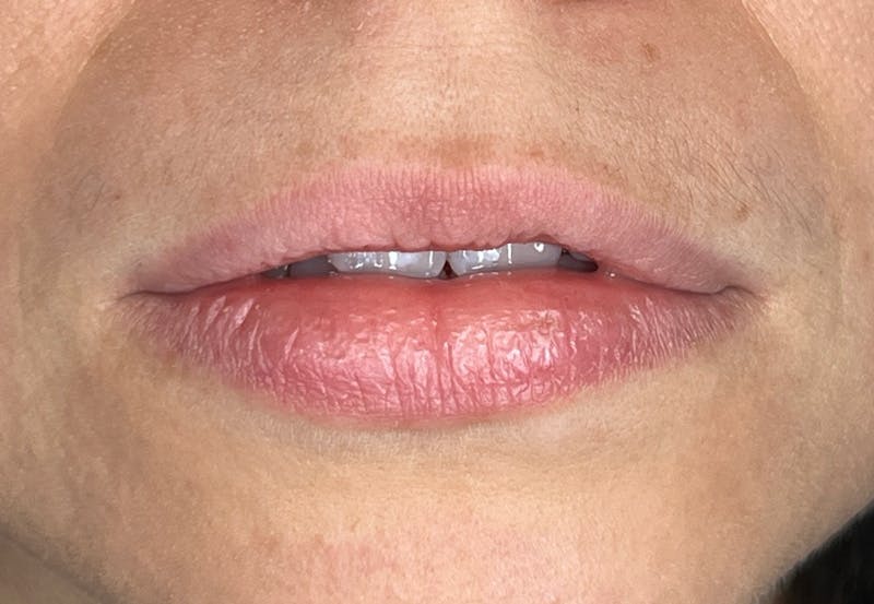 Lip Filler Before & After Gallery - Patient 435849 - Image 1