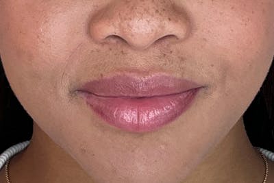 Lip Filler Before & After Gallery - Patient 169040 - Image 1