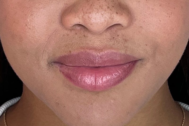 Lip Filler Before & After Gallery - Patient 169040 - Image 1