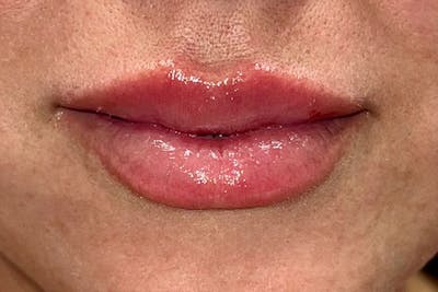 Lip Filler Before & After Gallery - Patient 367668 - Image 2