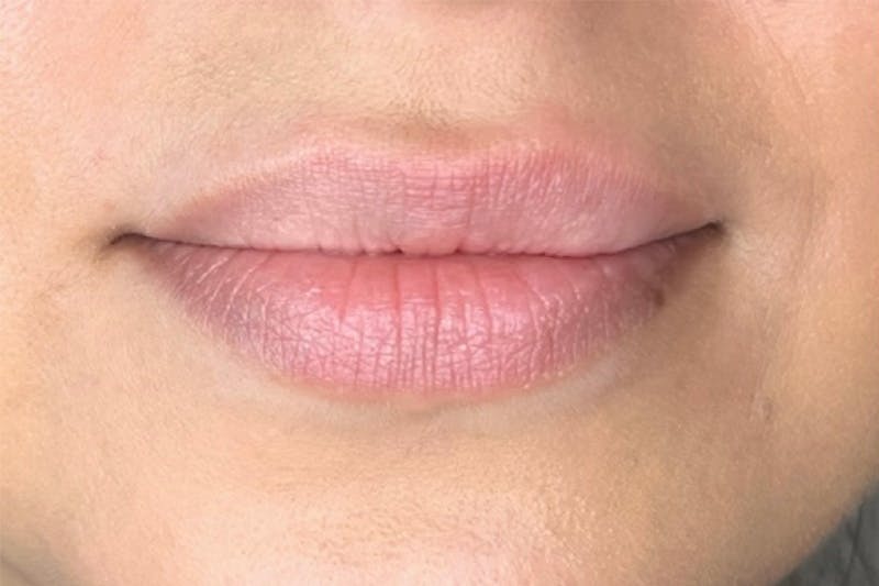 Lip Filler Before & After Gallery - Patient 246837 - Image 1