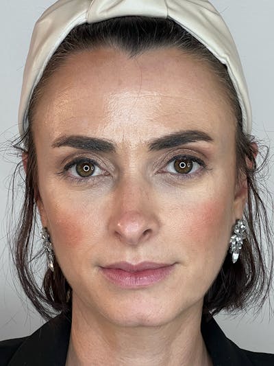 Facial Filler Before & After Gallery - Patient 370702 - Image 1