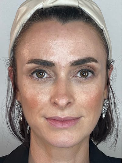 Facial Filler Before & After Gallery - Patient 370702 - Image 2