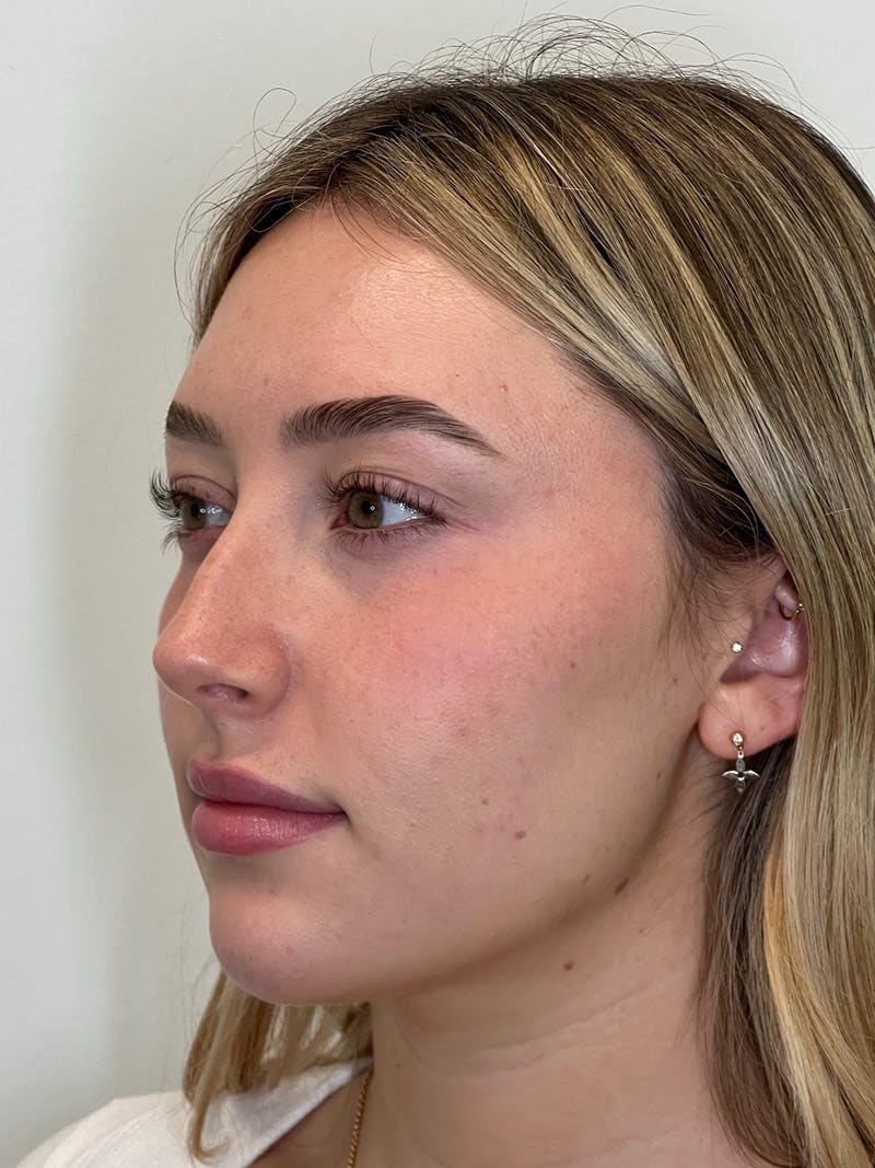 Facial Filler Before & After Gallery - Patient 201265 - Image 2