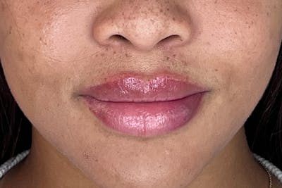 Lip Filler Before & After Gallery - Patient 169040 - Image 2
