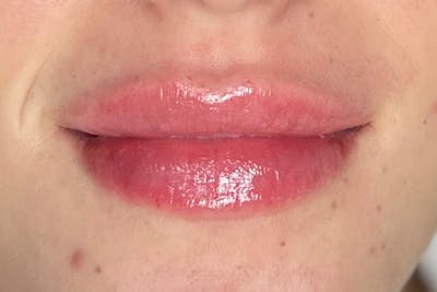 Lip Filler Before & After Gallery - Patient 216582 - Image 2